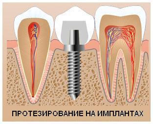 Новости Днепра про Имплантация зубов в стоматологии «Angeldent»!