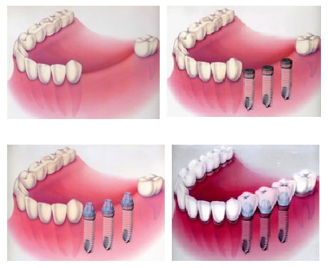 Новости Днепра про Имплантация зубов в стоматологии «Angeldent»!
