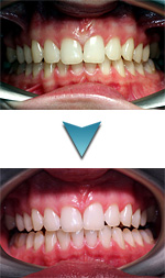 Новости Днепра про Аппаратное отбеливание зубов системой Beyond в стоматологии «Дентим-А»!