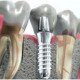 Восстановление здоровья ваших зубов в стоматологии «Сан Марко»!