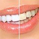Отбеливание зубов в  стоматологии «San Marco»