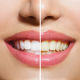 Лазерное отбеливание зубов – современный и безопасный метод