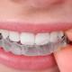 Отличная новость от клиники «Сан Марко»: ровные зубы без брекетов – это просто!