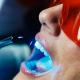 Клиника «Сан Марко» предлагает эффективное отбеливание зубов по инновационной методике