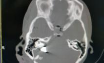 Переломы черепа и травмы мозга: в Днепре умерла девушка, пострадавшая от взрыва