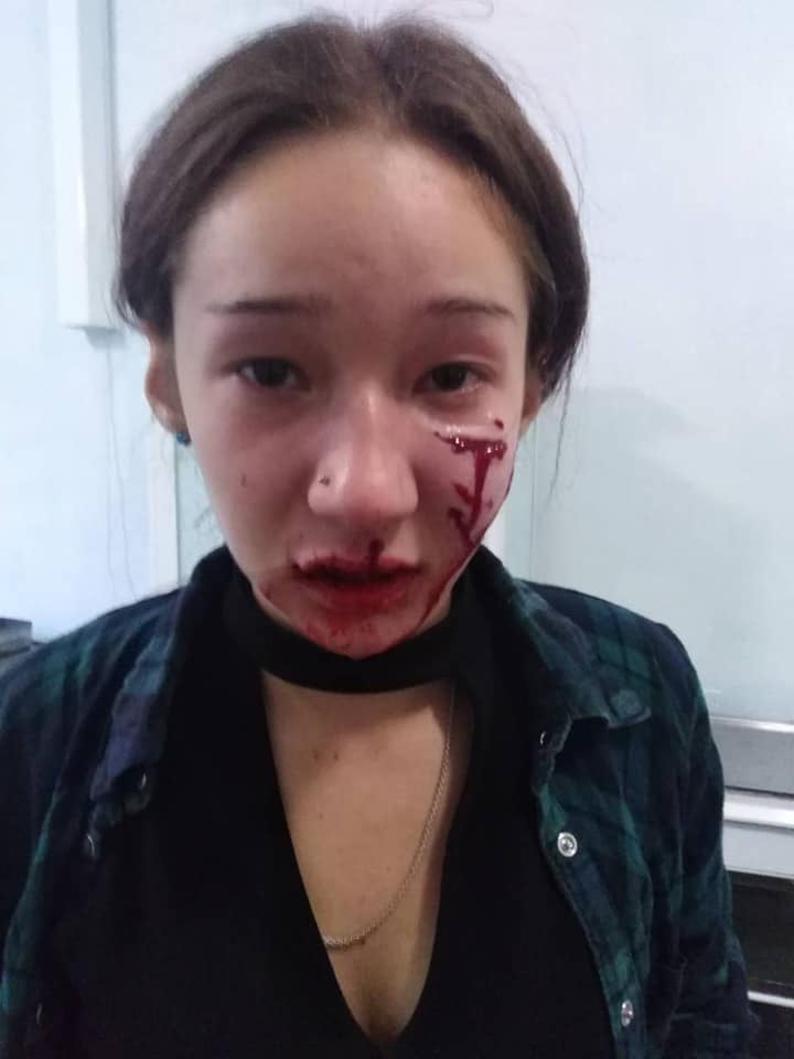 Новости Днепра про На Днепропетровщине собака сорвалась с цепи и разорвала школьнице лицо