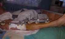 Уламками перебило ногу: у лікарні Дніпра врятували Захисника