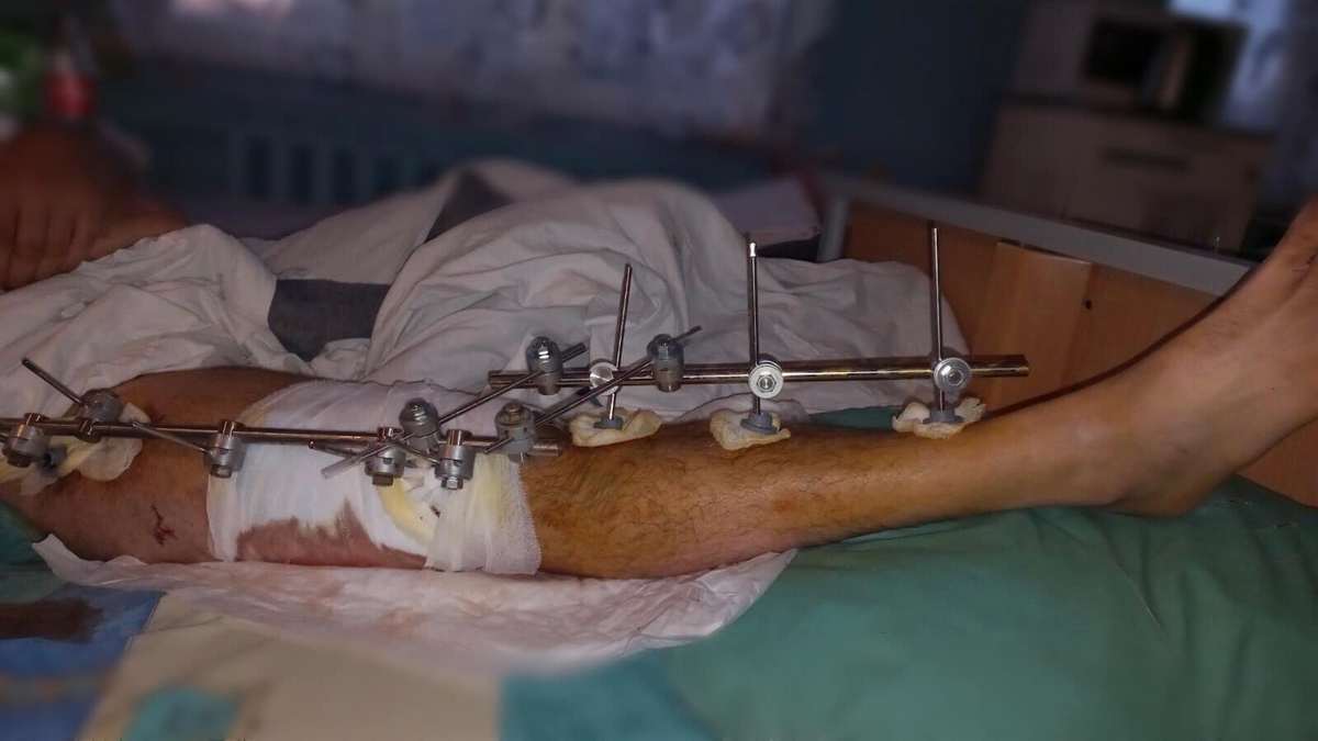 Новости Днепра про Уламками перебило ногу: у лікарні Дніпра врятували Захисника