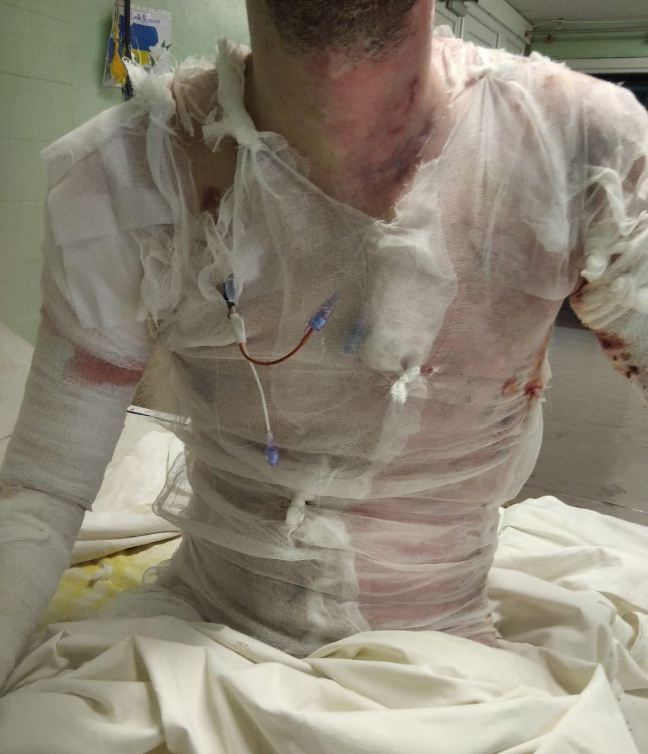 Новости Днепра про Побував в пеклі: у Дніпрі врятували 23-річного бійця, чиє тіло обгоріло на 70%