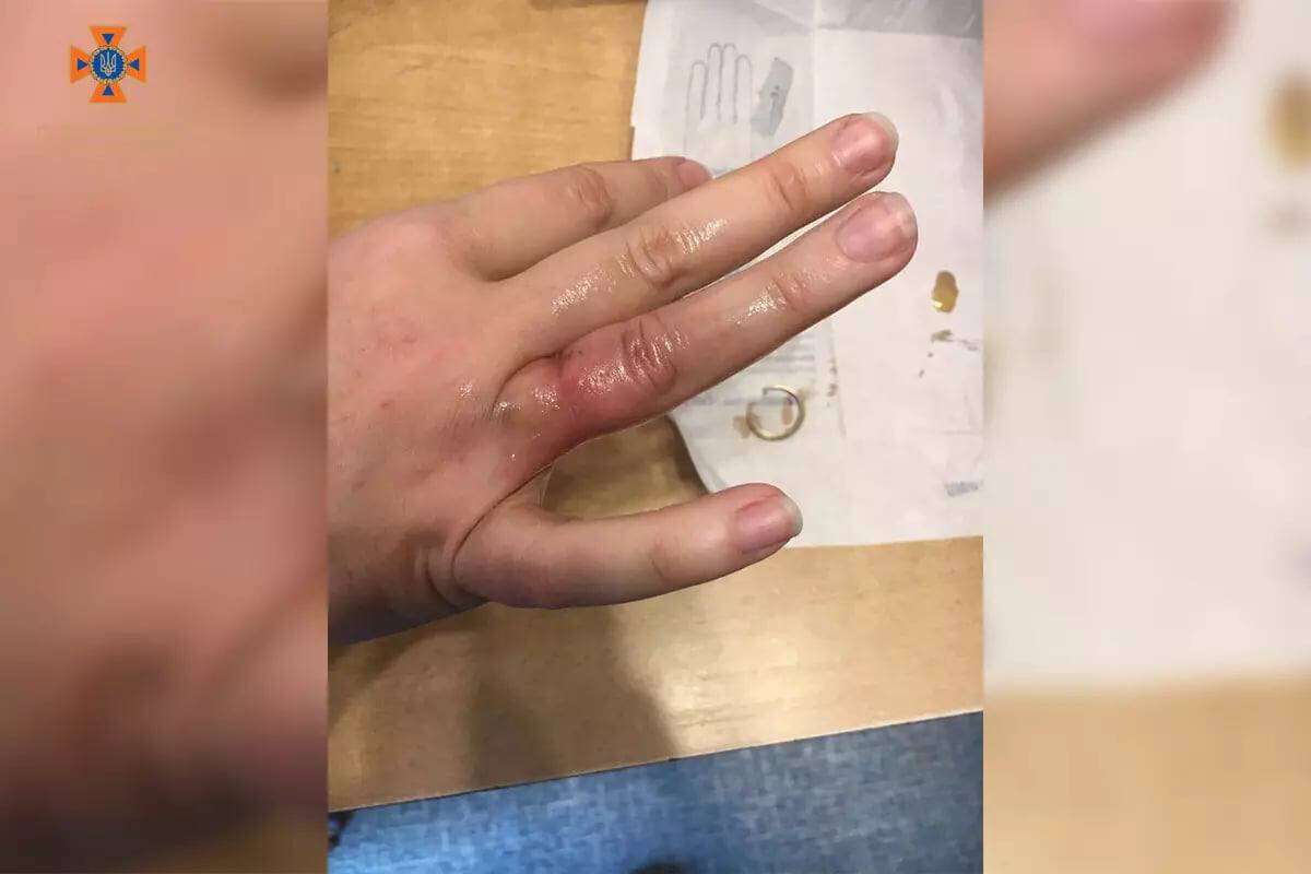 Новости Днепра про Спасатели в Днепре дважды за день снимали кольца с пальцев женщин