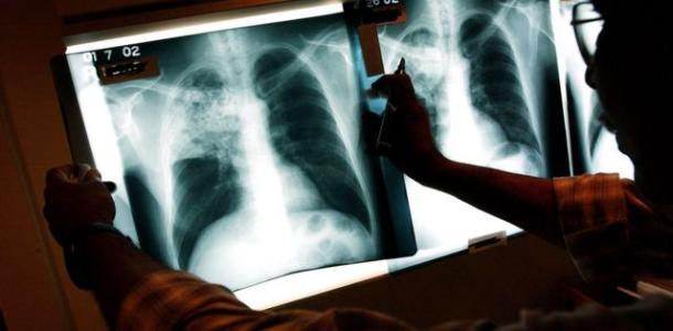Днепропетровщина лидер по количеству больных туберкулезом